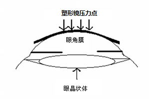 角膜塑形用硬性透氣接觸鏡說明書編寫指導(dǎo)原則（2020年修訂版）（2020年第47號(hào)）(圖1)