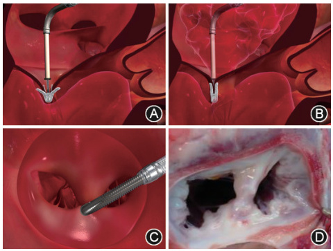 經導管二尖瓣夾系統醫療器械注冊證辦理指南(圖2)