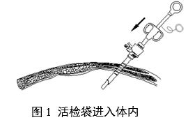 一次性使用內窺鏡用活檢袋注冊審查指導原則(2025年第20號)(圖1) 一次性使用內窺鏡用活檢袋注冊審查指導原則(2025年第20號)(圖1)