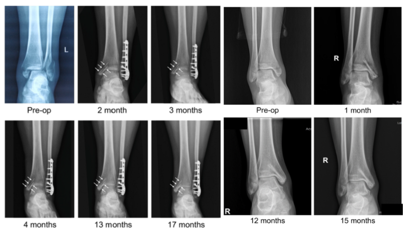 醫用鎂合金骨內植物臨床試驗研究突破性進展(圖2) 醫用鎂合金骨內植物臨床試驗研究突破性進展(圖2)