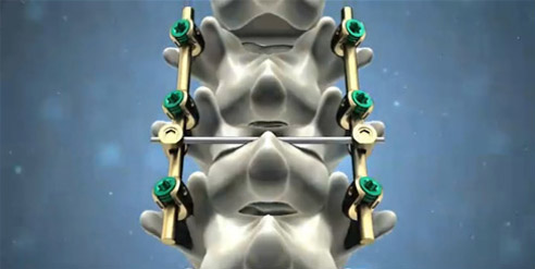 脊柱后路內固定系統(tǒng)注冊技術審查指導原則(2016年第70號)(圖1) 脊柱后路內固定系統(tǒng)注冊技術審查指導原則(2016年第70號)(圖1)